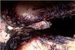 Cover for Fusobacterium necrophorum infections