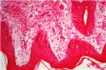 Histology Early changes in a skin lesion.