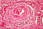 Histology Vasculitis and peri-vasculitis.