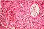 Histology Thrombosis in blood vessel.