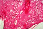 Histology Epidermal hyperplasma and balloon degeneration.