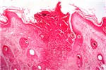 Histology Sitfast or late necrotic lesion.