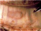 Pathology An LSD (pox) lesion in the tracheal mucosa.