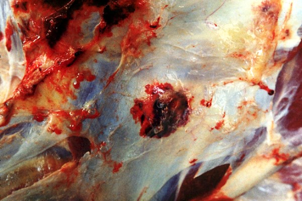 Pathology Lesions in muscle.