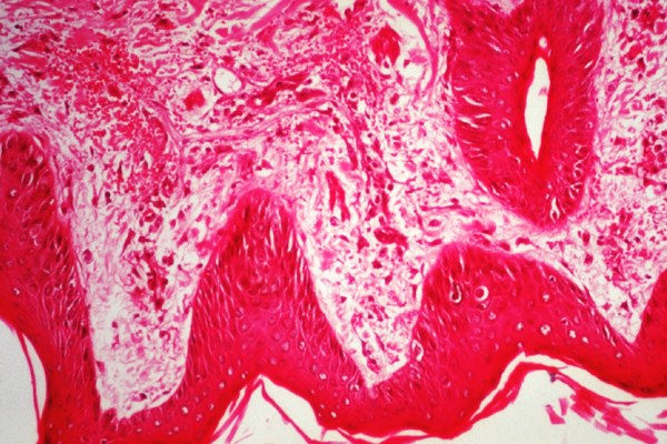 Histology Early changes in a skin lesion.
