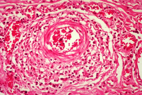 Histology Vasculitis and peri-vasculitis.