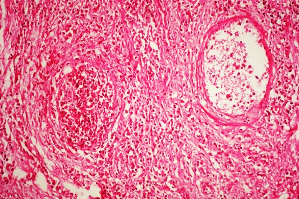 Histology Thrombosis in blood vessel.