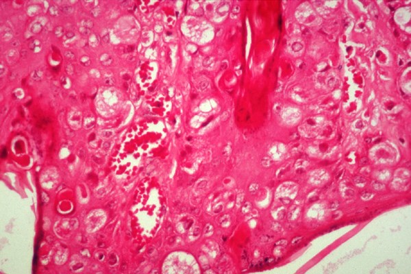 Histology Epidermal hyperplasma and balloon degeneration.