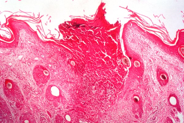 Histology Sitfast or late necrotic lesion.