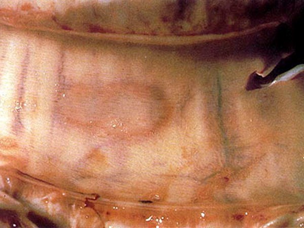 Pathology An LSD (pox) lesion in the tracheal mucosa.