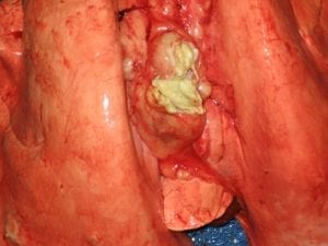 Fig. 8.10E. Lungs of sheep with caseous lymphadenitis abscess caused by infection with the bacterium Corynebacterium pseudotuberculosis. (Courtesy of Dr Paula Menzies.)