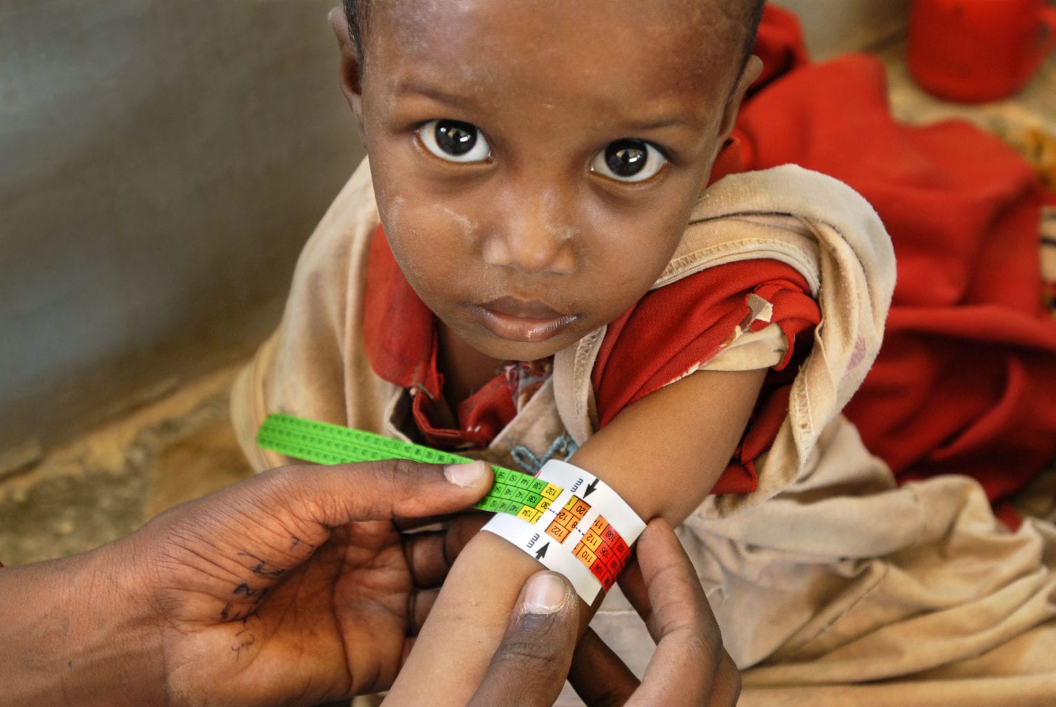 Malnourished child in east Africa
